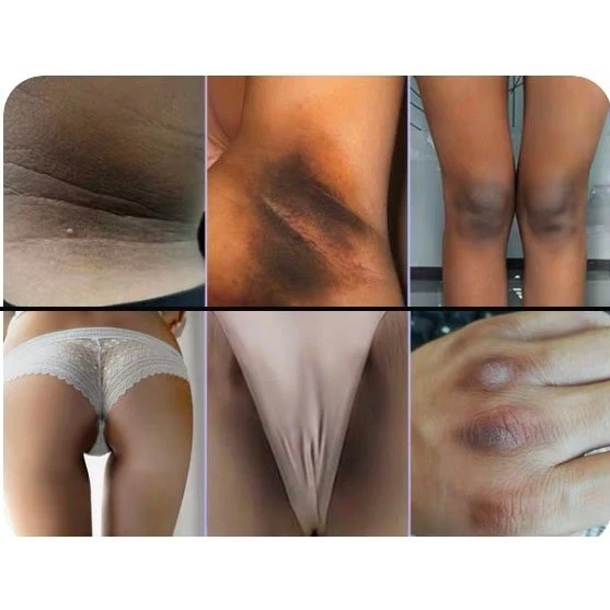 Clareamento Da Virilha E Axilas/Pele Do Grão /creme clareador de virilha e axilas/creme clareador de pele/creme para clarear axila e virilha/creme clareador corporal - Imagem 5