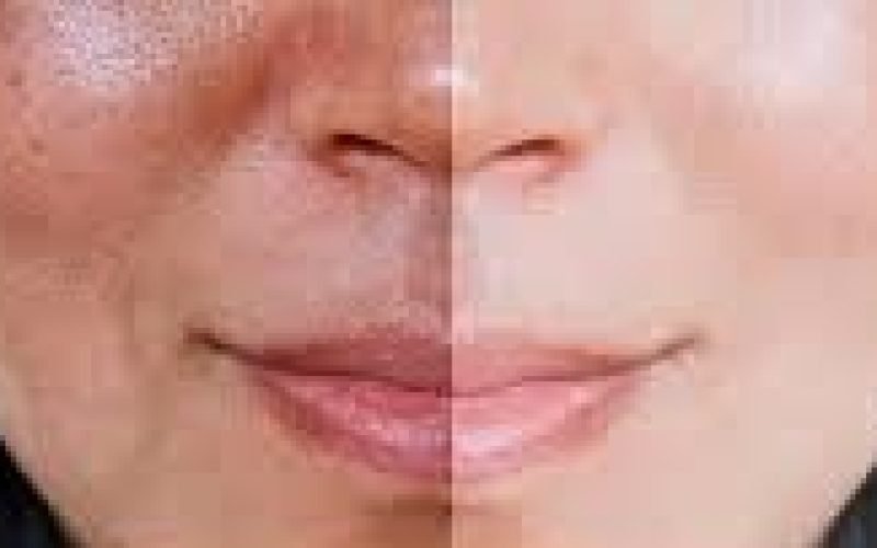 Novas Técnicas de Clareamento: Beleza e Tecnologia a Favor do Sorriso